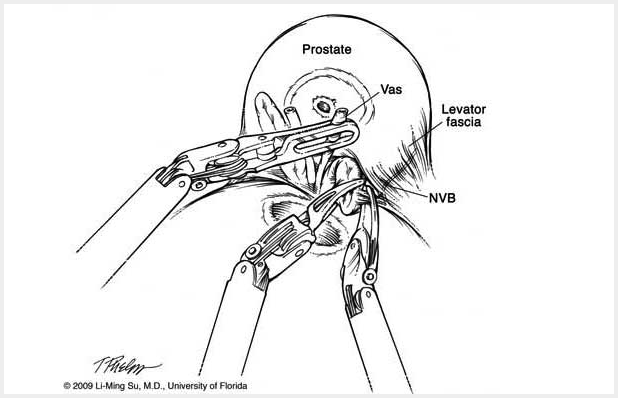 Anatomical illustration of seminal vesicle dissection from the supplied guideline