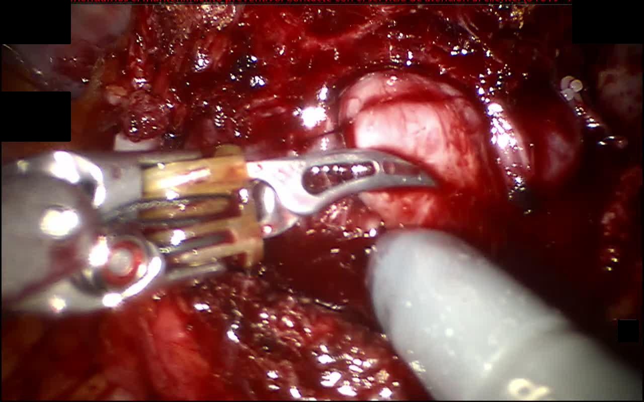 Bipolar Forceps