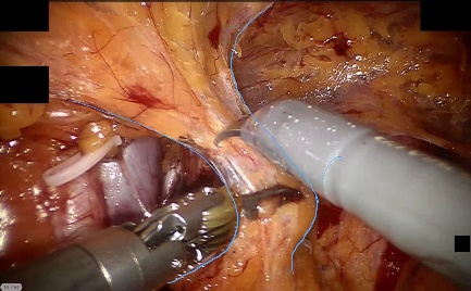Subperitoneal adipose tissue — example 2