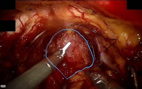 Prostate — example 1