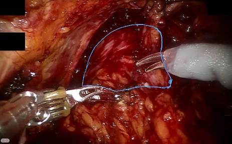 Prostate — example 2