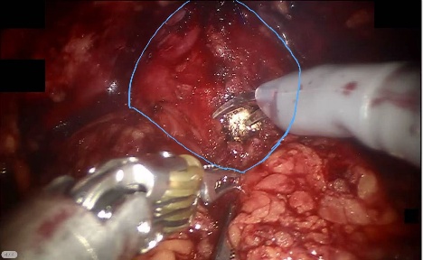 Prostate — example 3