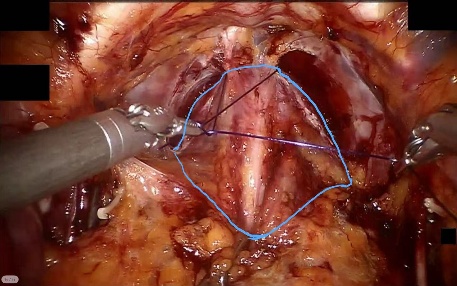 Prostate — example 4