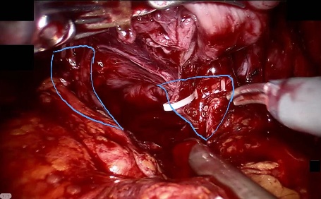 Lateral Prostatic Ligament — example 1