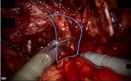 Lateral Prostatic Ligament — example 2