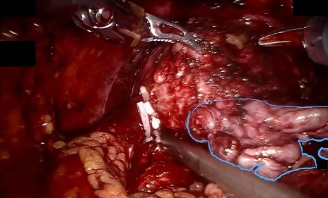 Seminal vesicle — example 1