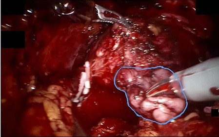 Seminal vesicle — example 2
