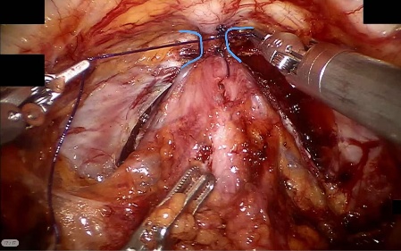 Dorsal venous complex — example 1