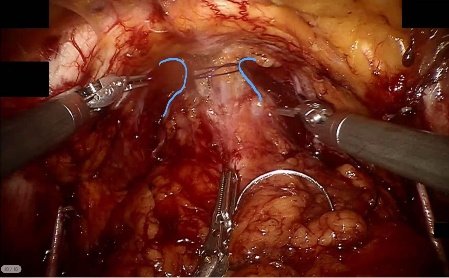 Dorsal venous complex — example 2