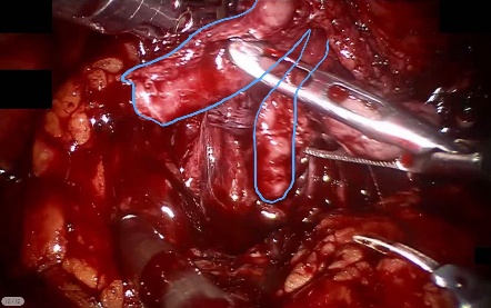 Vas deferens — example 1