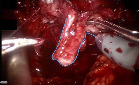 Vas deferens — example 2