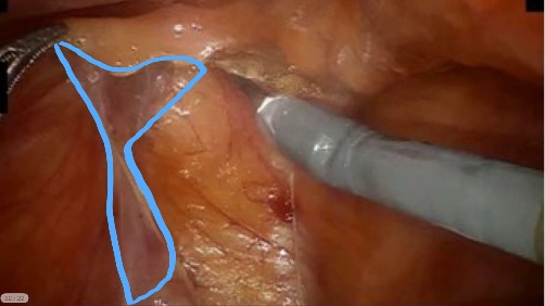 Peritoneum — example 1