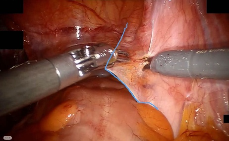Peritoneum — example 2