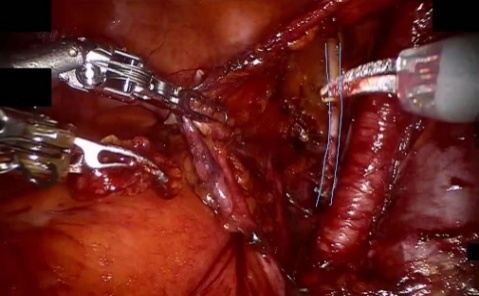 Obturator nerve — example 1