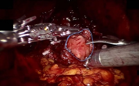 Bladder neck — example 1