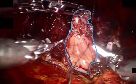 Bladder neck — example 2