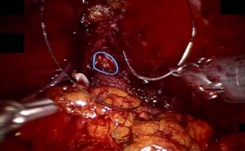 Urethra — example 1