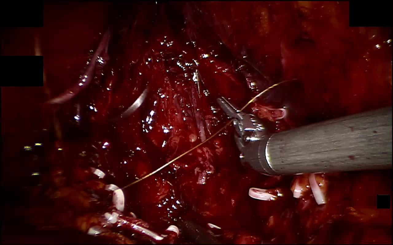 Large Needle Driver