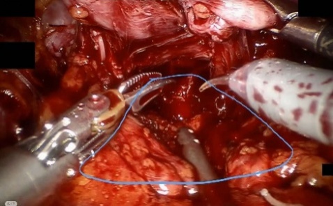 Rectum — example 1