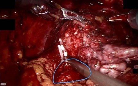Rectum — example 2