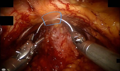 Below the pubic symphysis — example 1