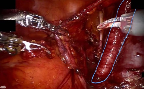 External iliac vessels — example 1