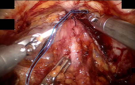 Suture — example 1