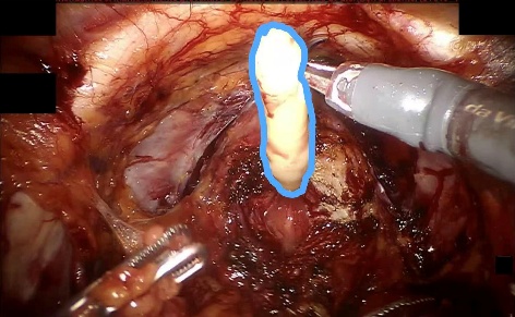 Urethral Catheter — example 1