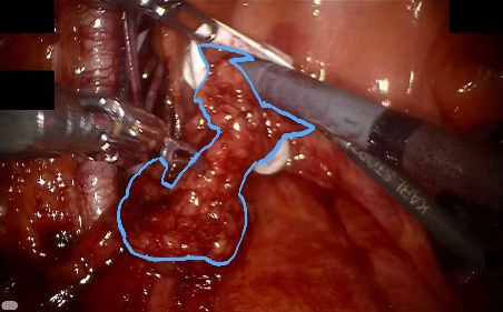Subperitoneal adipose tissue — example 1