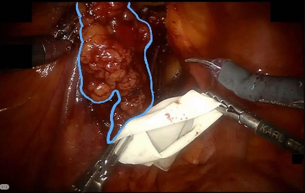 Subperitoneal adipose tissue — example 2