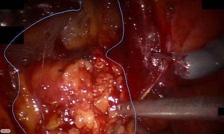 Subperitoneal adipose tissue — example 1